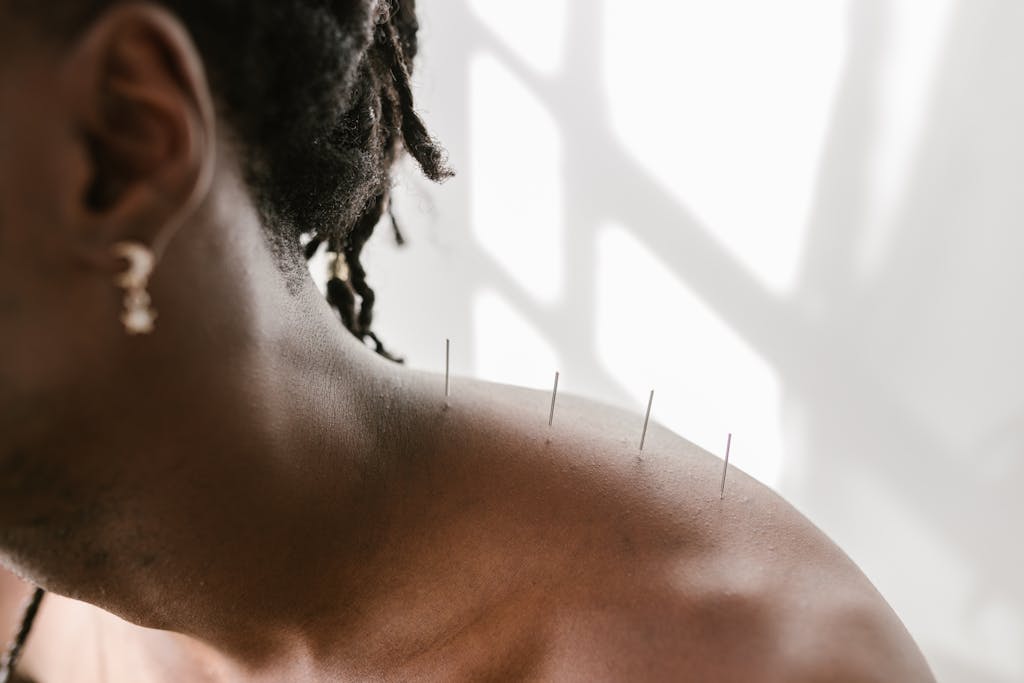 A Man Undergoing Acupuncture